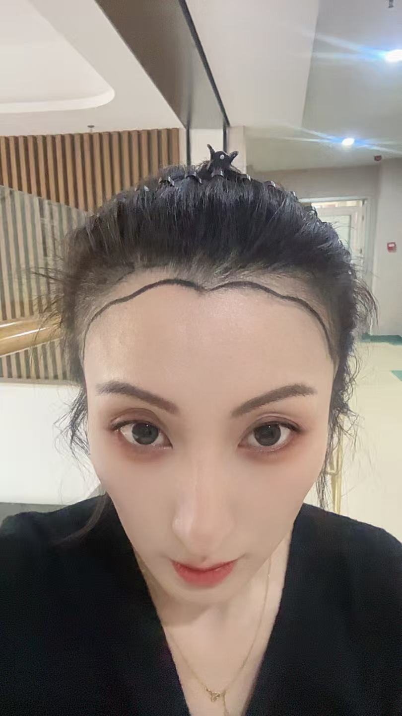 29岁女职员:产后脱发改善成功案例1